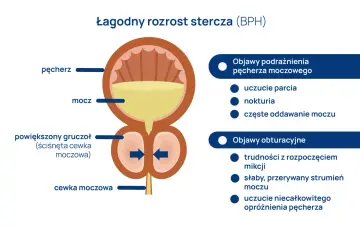 Ilustracja przedstawia łagodny rozrost stercza (BPH) i jego objawy. Powiększony gruczoł uciska cewkę moczową, co może wymagać leczenia, np. tamsulozyną.