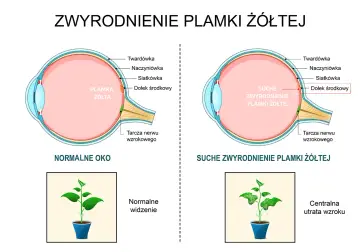 Porównanie zdrowego oka z suchym zwyrodnieniem plamki żółtej. Pokazuje, jak szybko powiększa się otwór plamki żółtej, prowadząc do utraty wzroku.