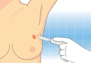 Wykonanie biopsji gruboigłowej piersi. Lekarz w białej rękawiczce zbliża skalpel do podejrzanej zmiany na piersi.