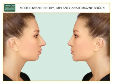 Przed i po modelowaniu brody. Zabieg poprawiający profil twarzy.