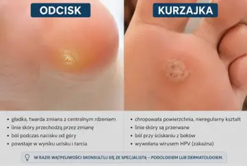 Porównanie kurzajki i odcisku na stopie. Kurzajka jest chropowata i wywołana wirusem, a odcisk gładki i powstaje od ucisku.