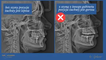 Rentgen żuchwy: po lewej bez szyny, pozycja lepsza. Po prawej z szyną na staw skroniowo żuchwowy, pozycja gorsza.