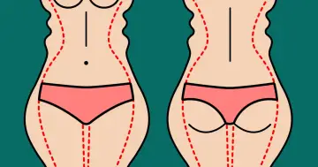 Ilustracja pokazuje sylwetkę przed i po zabiegu liposukcji ud. Czerwone linie zaznaczają obszary do modelowania.