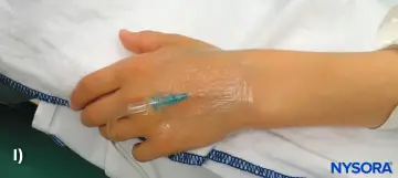 Ein Zugang am Handrücken, wo tut ein zugang am wenigsten weh? Hier wird ein Infusionsschlauch an einer Hand befestigt.