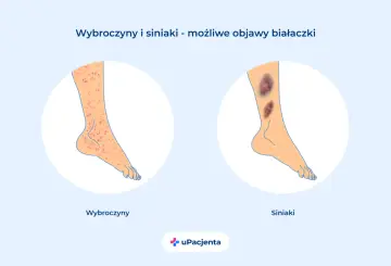 Wybroczyny i siniaki na nogach mogą być objawem ostrej białaczki szpikowej. Ilustracja pokazuje nogę z licznymi czerwonymi plamkami (wybroczyny) i nogę z dużymi, ciemnymi siniakami.