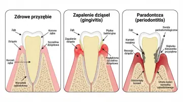 Ilustracja pokazuje etapy paradontozy: zdrowe przyzębie, zapalenie dziąseł i zaawansowaną paradontozę z utratą kości.