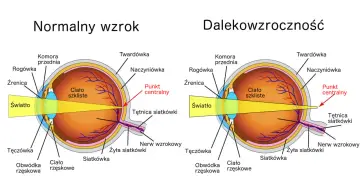 Porównanie oka z prawidłowym widzeniem i oka z nadwzrocznością. Promienie światła skupiają się za siatkówką.