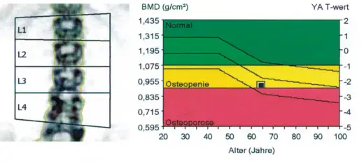 Osteoporose-Wertetabelle - So deuten Sie T-Score & Z-Score richtig