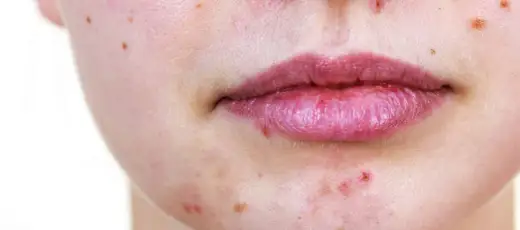 Microkystes du visage - comment les reconnaître et les traiter
