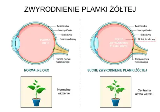 Suche oko - powikłania, objawy, leczenie. Chroń swój wzrok!