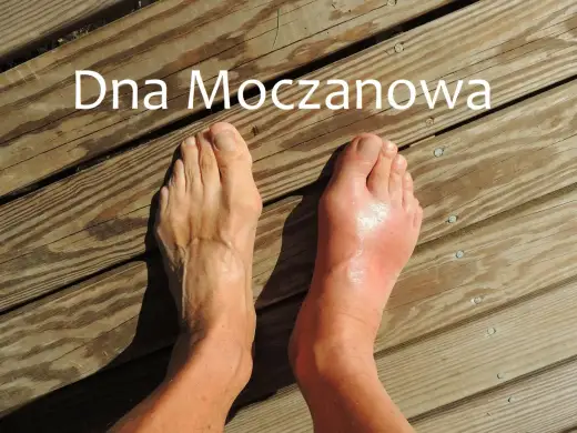 Ból pięty przy dnie moczanowej - jak odróżnić go od przeciążenia?