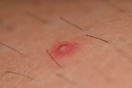 Zmiany na karku - Trądzik czy zapalenie mieszków?