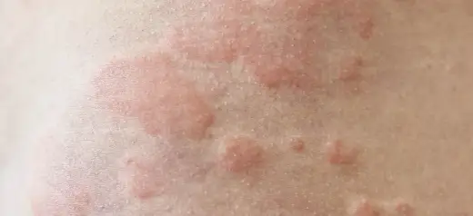 Pokrzywka na twarzy - Jak rozpoznać bąble i czy to zawsze alergia?