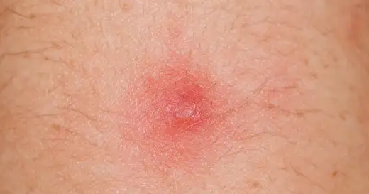 Detreomycyna 2 na cerę - Kiedy używać, a kiedy nie?