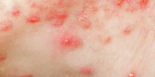 Głębokie bolesne zmiany pod skórą - Przyczyny, leczenie, pielęgnacja