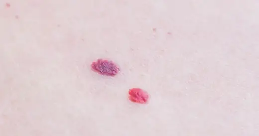 Czerwone pieprzyki - jak je rozpoznać i kiedy iść do dermatologa