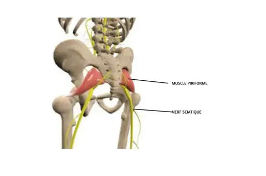 Douleur du piriforme - combien de temps dure-t-elle ?