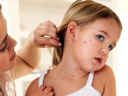 Sarpullido por fiebre en niños - cuándo consultar y qué vigilar