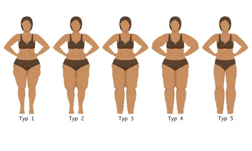 Lipedema u szczupłych osób - jak odróżnić ją od zwykłej sylwetki?