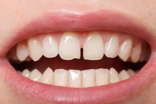 Diastema - kiedy leczyć przerwę między zębami?