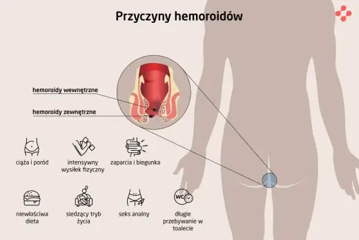 Krew z odbytu w ciąży - jak rozpoznać hemoroidy i kiedy reagować?