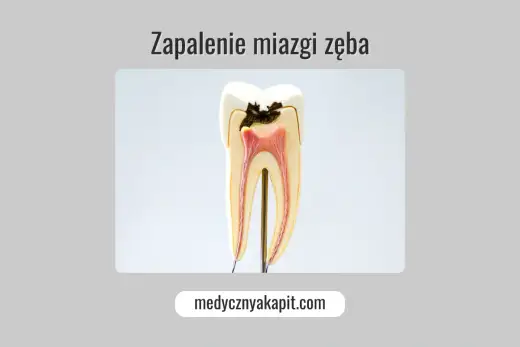 Zapalenie miazgi zęba - Jak rozpoznać i skutecznie leczyć?