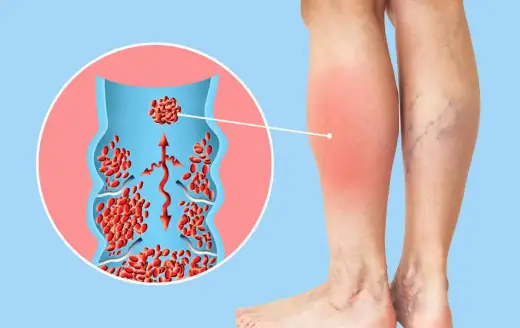 Thrombose im Alter - Symptome erkennen & richtig handeln
