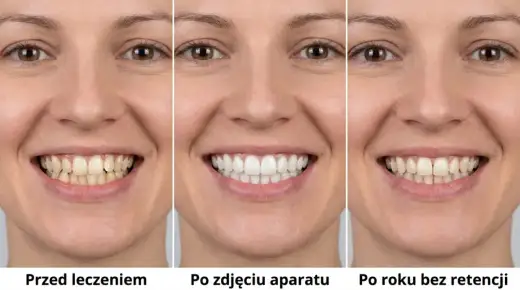 Drut retencyjny - Utrzymaj idealny uśmiech na lata!