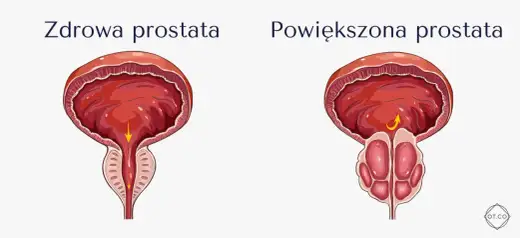 Leki na prostatę - Co naprawdę działa? Wybierz właściwą terapię!