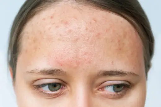 Alergia na mleko u dorosłych: objawy skórne, diagnoza i leczenie