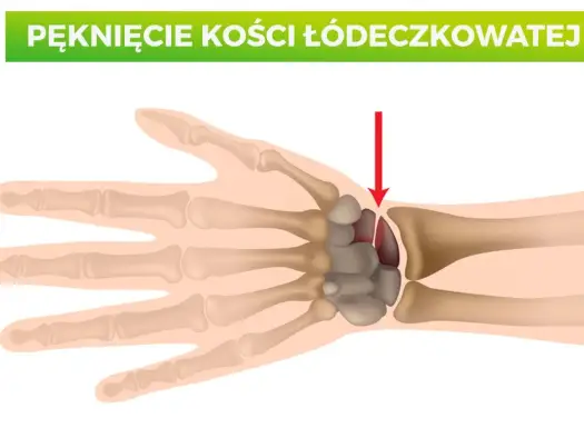 Ból kciuka po upadku? To może być złamanie kości łódeczkowatej