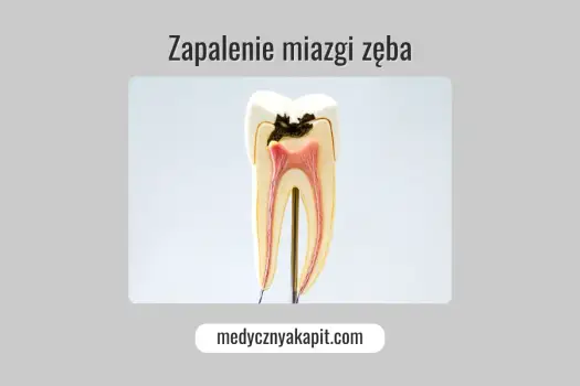 Zapalenie miazgi zęba - objawy, leczenie, ratunek dla zęba