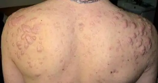 Trądzik na plecach - Skuteczna pielęgnacja i kiedy do lekarza?