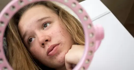 Trądzik u nastolatków - jak ułożyć rutynę i kiedy do dermatologa