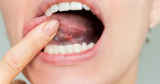 Ból i obrzęk pod językiem - Kiedy do dentysty?