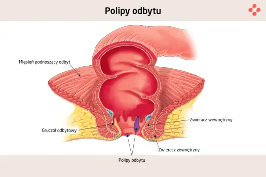 Polip to nowotwór? Kiedy jest łagodny, a kiedy przedrakowy