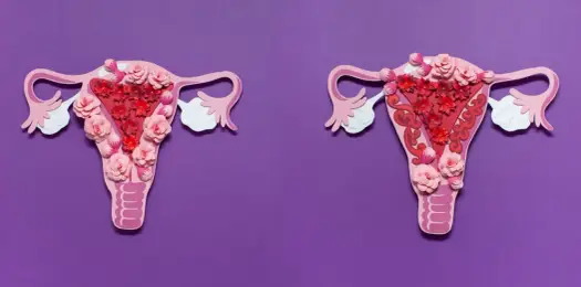 Bolesne miesiączki - czy to adenomioza? Objawy, diagnoza, leczenie