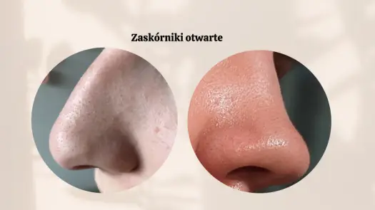 Zaskórniki na nosie: Skuteczne sposoby i jak ich unikać