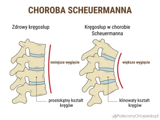 Kifoza Scheuermanna - jak ją rozpoznać i leczyć?