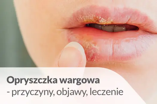 Opryszczka na ustach - Ile trwa i jak skrócić gojenie?