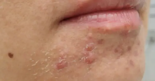 Pryszcze na brodzie - Przyczyny, pielęgnacja i kiedy do dermatologa?