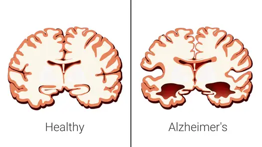 Alzheimer - Co naprawdę zabija? Powikłania, opieka paliatywna