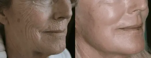 Najmocniejsze peelingi chemiczne: TCA vs Fenol - efekty i ryzyko
