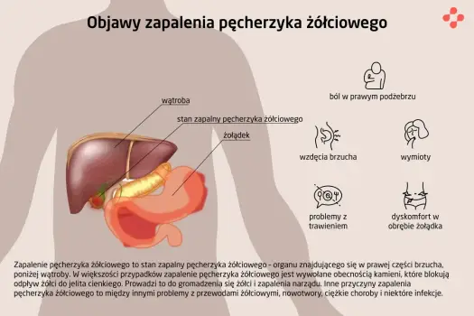 Zapalenie woreczka żółciowego - objawy, badania i leczenie