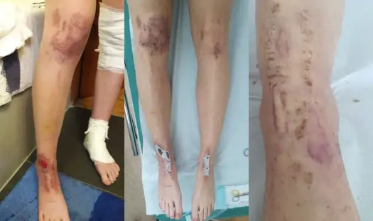 Oparzenia po depilacji laserowej - Co robić i kiedy do lekarza?
