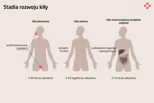 Kiła - jak ją rozpoznać, zbadać i skutecznie leczyć