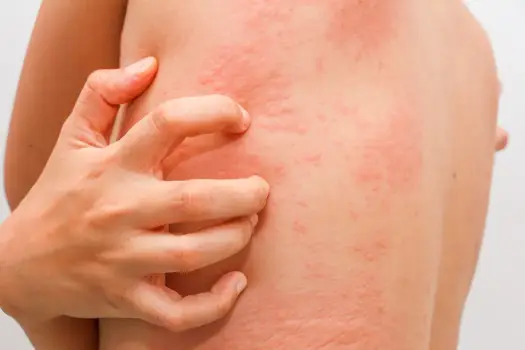 Reakcja skórna po lekach - kiedy to alergia, a kiedy infekcja?