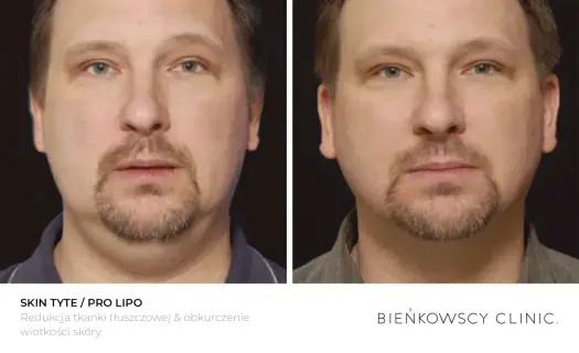 Lipoliza iniekcyjna - Czy to sposób na oporny tłuszcz?