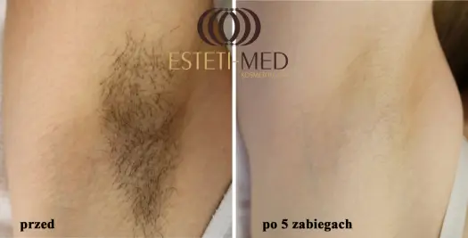Depilacja laserowa - Co ile zabieg? Maksymalizuj efekty!