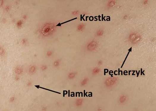 Ospa wietrzna u dziecka - Jak wygląda wysypka krok po kroku?